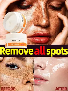 Vitamin C Beljenje Freckle Odstranjevanje Krema Učinkovito Odstrani Melasma Temne Lise Akne Znamk Strela Melanin Nego Obraza Kože
